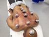 Hijama