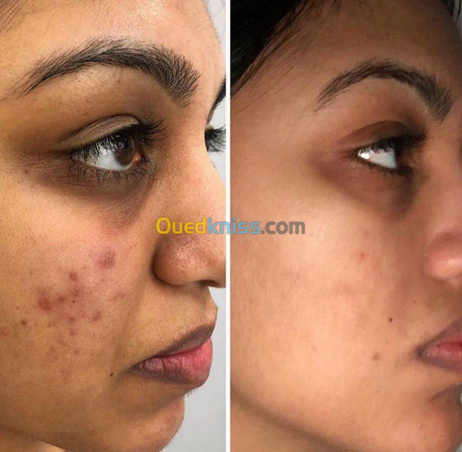 Microneedling 