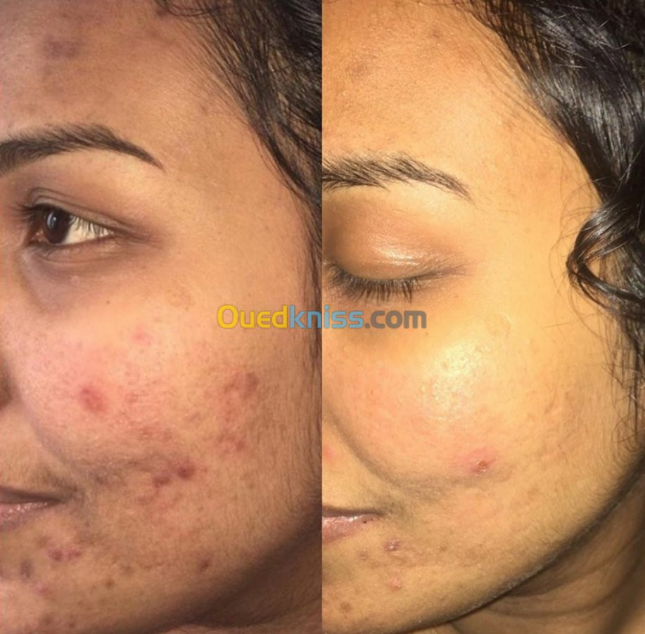 Microneedling 