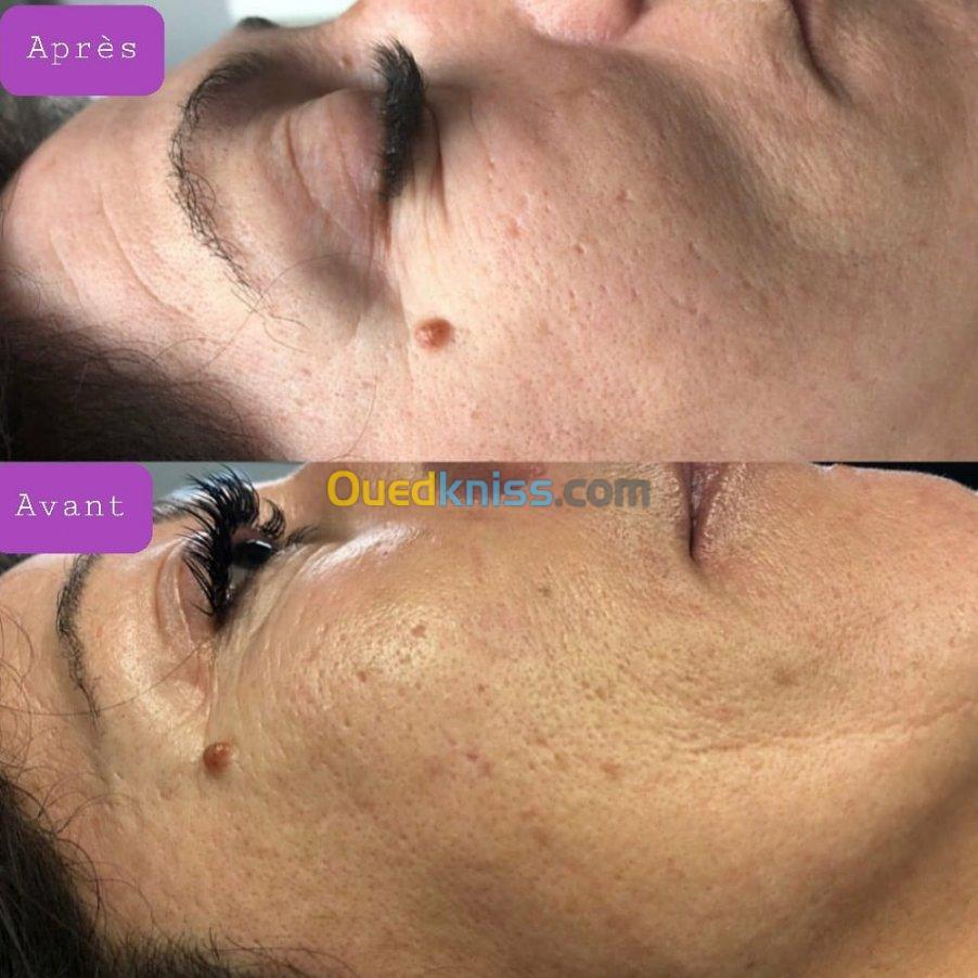 Microneedling 