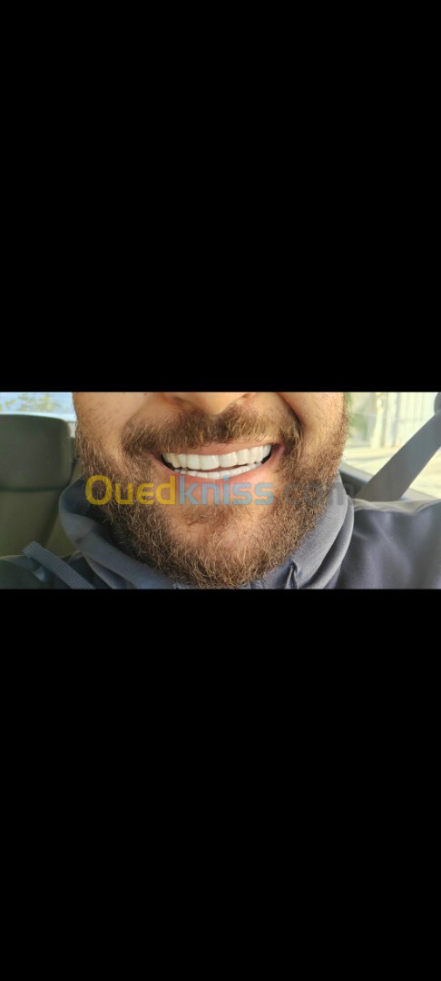 snap on smile sur mesure l'original 