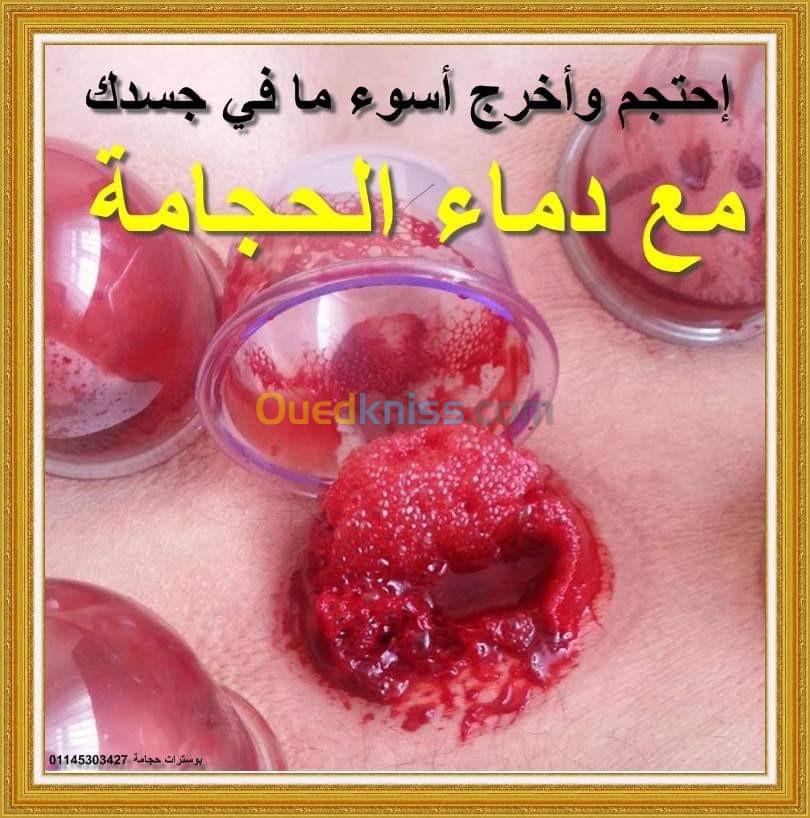 Hijama médical Acupuncture Hernie discale 