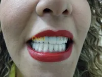 سيراميك زيركون زرع أسنان تبييض بالليزر
