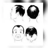 Implants capillaires