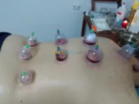 الحجامة الطبية 