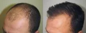 Greffe de cheveux زراعة الشعر بتركيا 