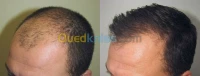 Greffe de cheveux زراعة الشعر بتركيا 