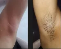 Épilation