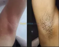 Épilation