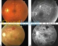 Examen ophtalmologie LASER YAG et LASER à L'ARGON