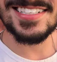 Snap on smaile