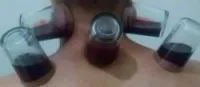الحجامة الوقائية والعلاجية السبالة