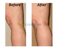 Varices de jambe