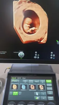 echographe GE volusson S10 à 4 sondes