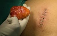 طب-و-صحة-traitement-chirurgical-ambulatorie-lipome-kyste-ongle-pied-diabetique-سطاوالي-الجزائر