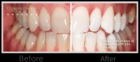 Opalescence PF 16% - Blanchiment Dentaire (4 seringues neuves 4x 1.2ml)  Teeth Whitening Gel 