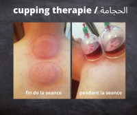 medecine-sante-hijama-a-domicile-حجامة-douera-alger-algerie