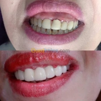 Soins,extractions,prothèse,blanchiment