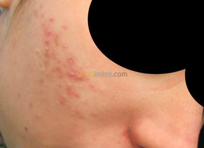 esthetique-beaute-acne-laser-معالجة-حب-الشباب-بالليزر-bab-el-oued-alger-algerie
