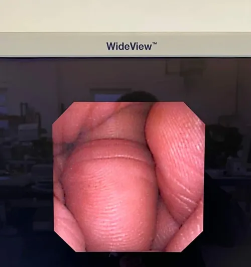 Vidéo Ureteroscope KARL STORZ