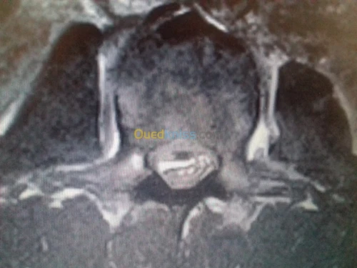 chirurgie neurologique EEG EMG