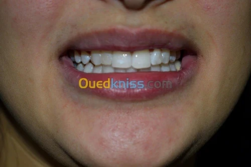 blanchiment dentaire professionnel 