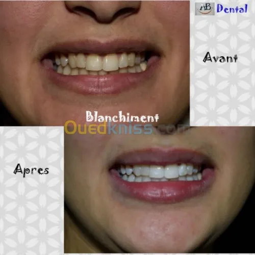 blanchiment dentaire professionnel 