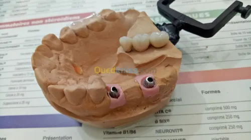 IMPLANTOLOGIE ( implant dentaire ) 