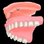 IMPLANTOLOGIE ( implant dentaire ) 