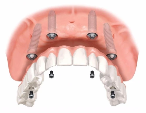 IMPLANTOLOGIE ( implant dentaire ) 