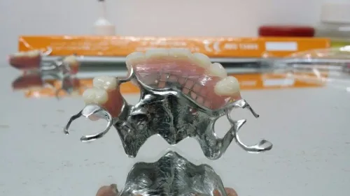 IMPLANTOLOGIE ( implant dentaire ) 