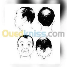 Implants capillaires