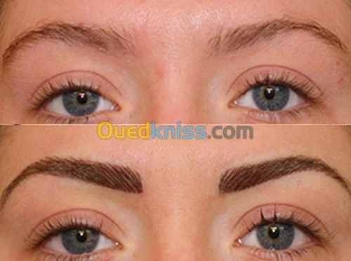 زراعة الشعر (شعر الراس، اللحية،الحواجب