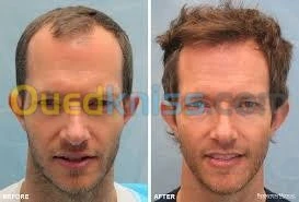 زراعة الشعر (شعر الراس، اللحية،الحواجب