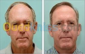 زراعة الشعر (شعر الراس، اللحية،الحواجب