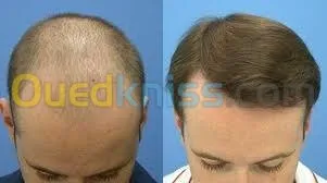 زراعة الشعر (شعر الراس، اللحية،الحواجب