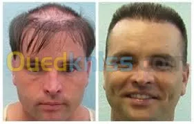 زراعة الشعر (شعر الراس، اللحية،الحواجب