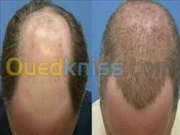 زراعة الشعر (شعر الراس، اللحية،الحواجب