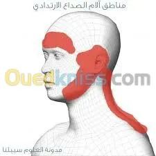 علاج الشقيقة والصداع والام المفاصل 