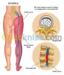 علاج الشقيقة والصداع والام المفاصل 