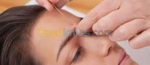 ACUPUNCTURE