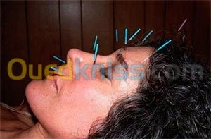 ACUPUNCTURE