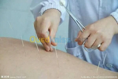 ACUPUNCTURE