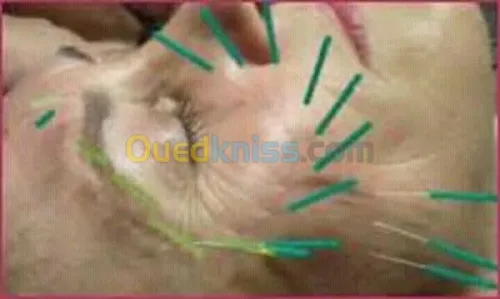 ACUPUNCTURE