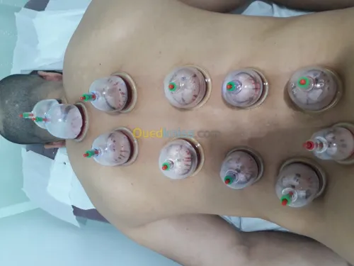 حجامة-hijama وقائية وعلاجية