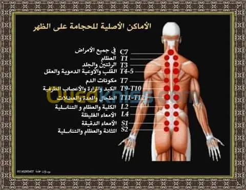 حجامة-hijama وقائية وعلاجية