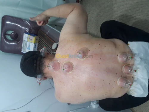 حجامة-hijama وقائية وعلاجية