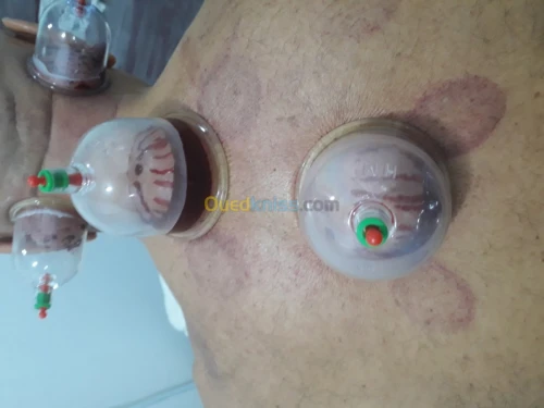حجامة-hijama وقائية وعلاجية