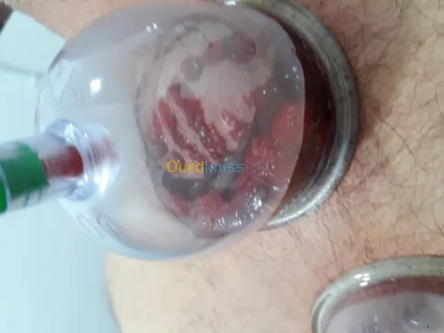 حجامة-hijama وقائية وعلاجية