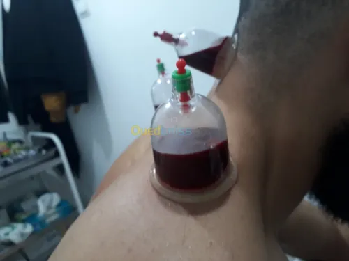 حجامة-hijama وقائية وعلاجية